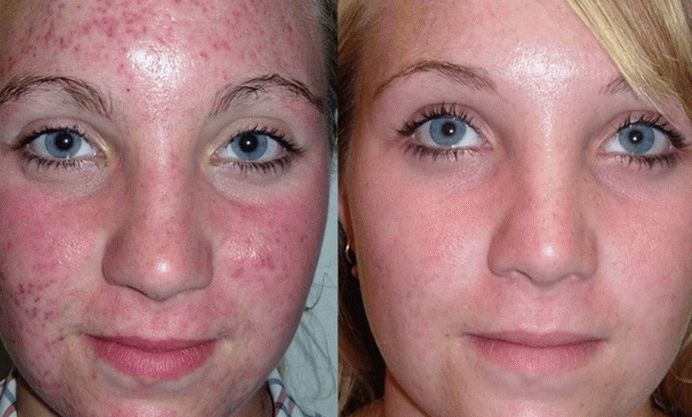 fotografija kože lica nakon liječenja psorijaze